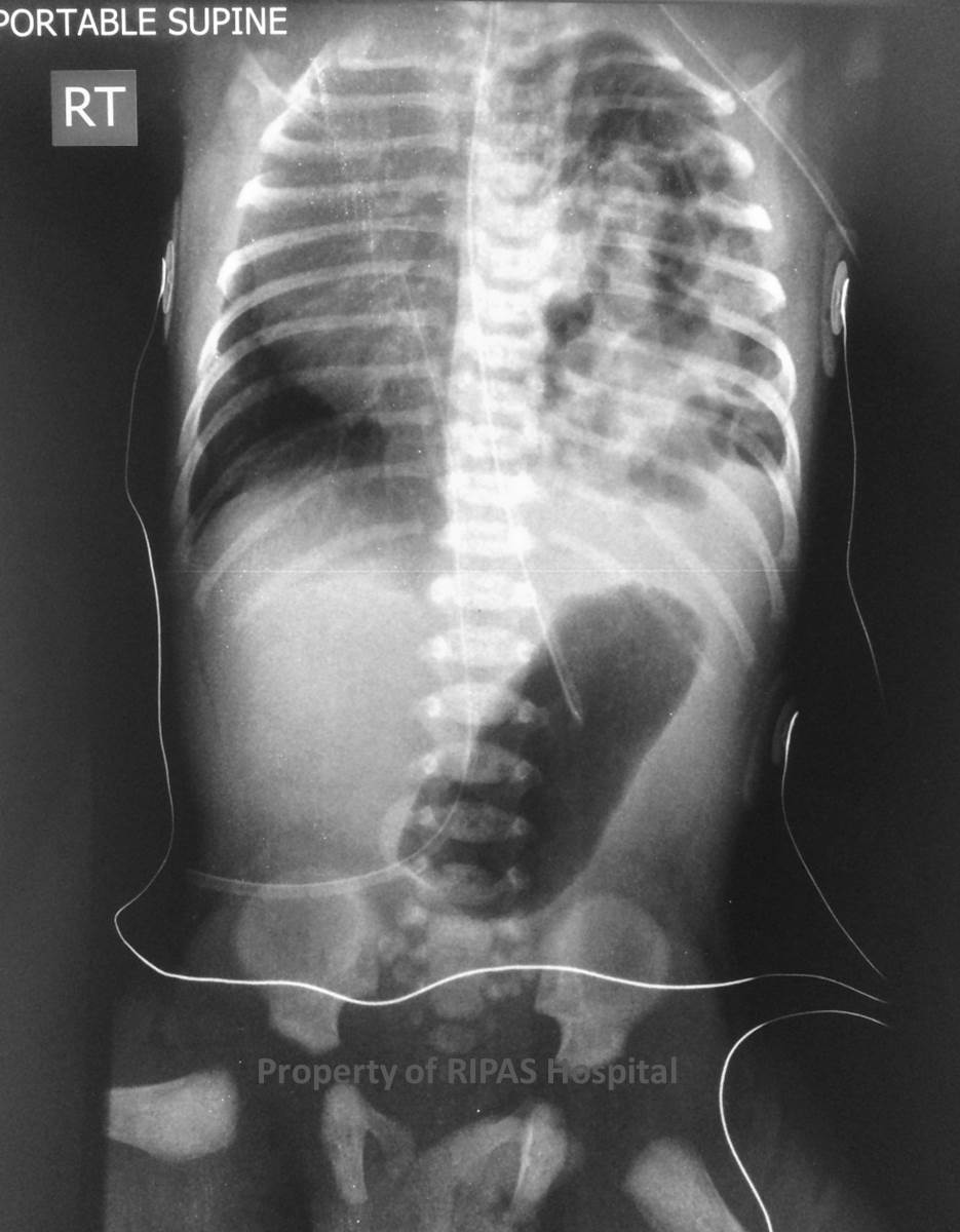 scaphoid abdomen in neonate